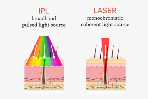 Laser vs IPL... What's the difference?